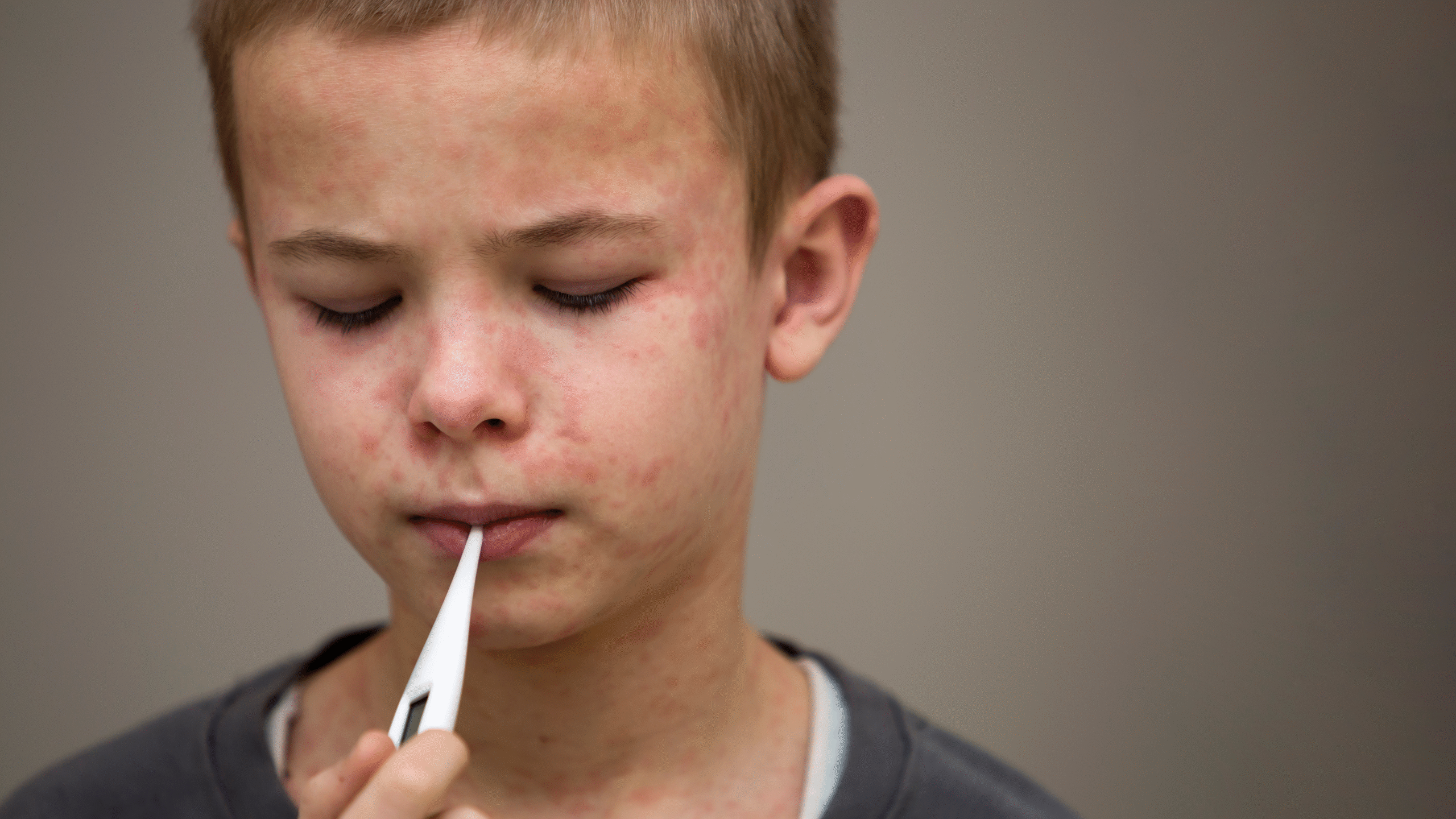 young boy with measles taking his temperature