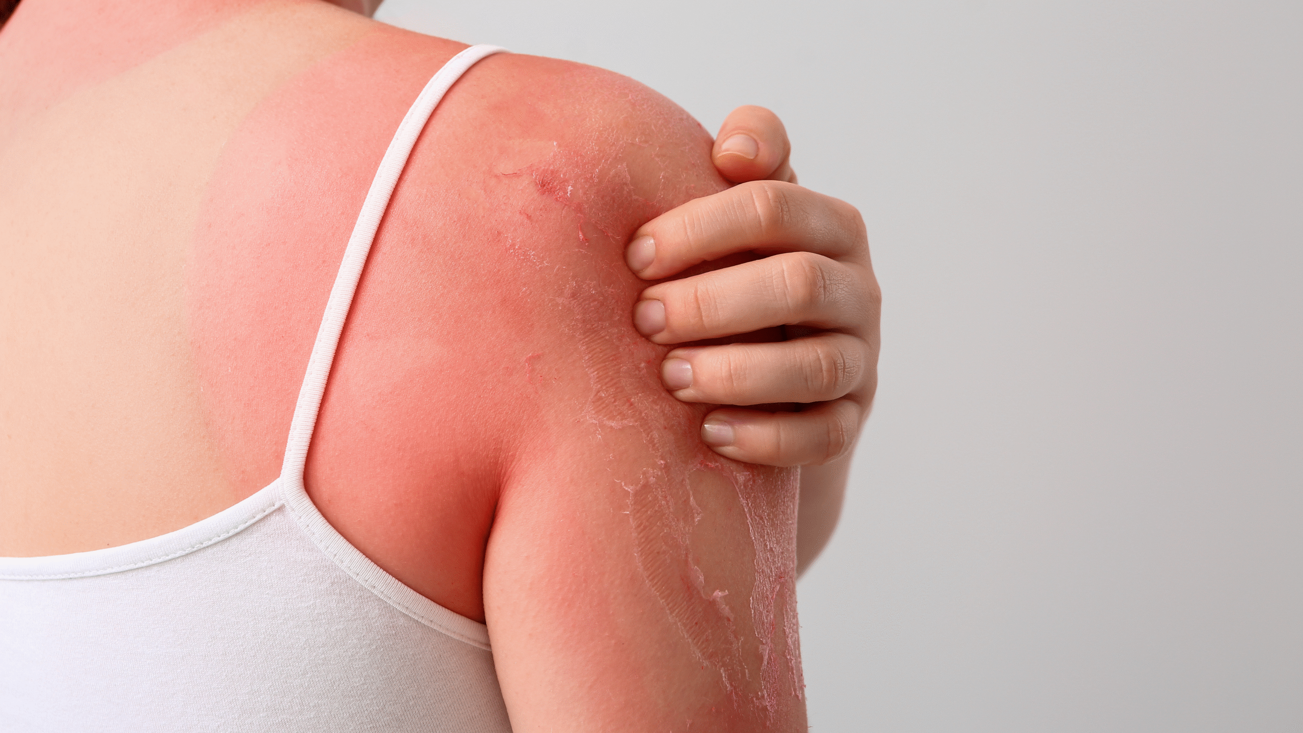 extremely red and peeling skin due to sunburn